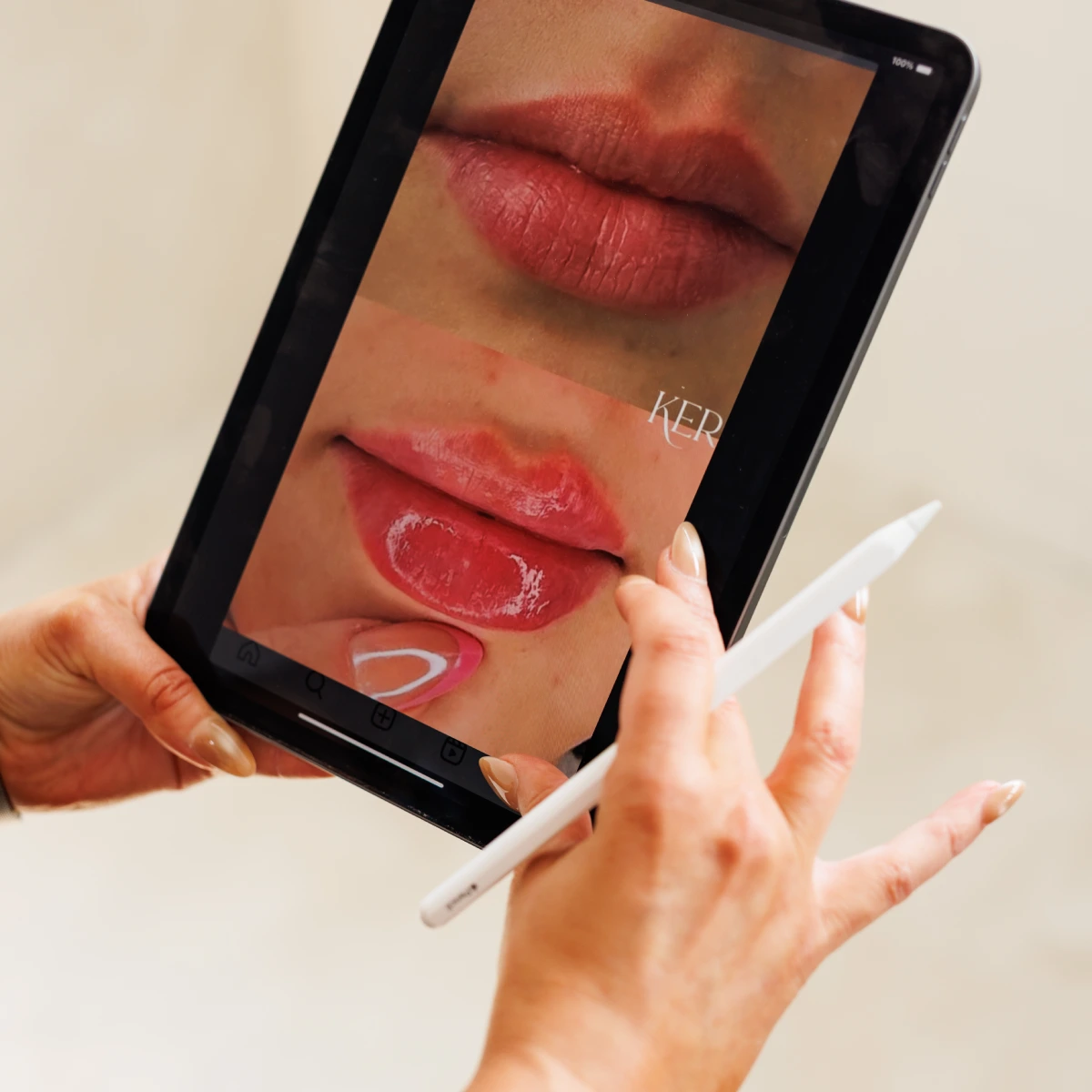 Lip Enhancement Solutions at Keraderm In Hawkesbury, ON