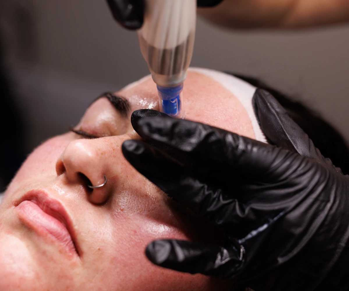 A woman is receiving Acne scars treatment at Keraderm In Hawkesbury, ON